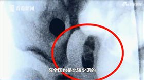 2歲童尿道卡「2公分乳白顆粒」！醫秒揪病因：這個補過頭（圖／翻攝自看看新聞）