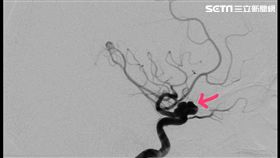 安南醫院,神經外科,張哲肇,頭痛,腦動脈瘤
圖／安南醫院提供