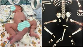 男嬰長「3腿2陰莖」卻沒肛門！神醫手術救回了（圖／翻攝自metro）