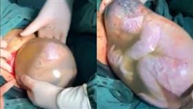 哪吒轉世？陸孕婦產下「帶殼寶寶」　透明膜包覆如水球（圖／翻攝自海峽都市報微博）