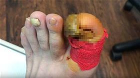 （圖／翻攝自Healthy Feet Podiatry YouTube）指甲,變形,拔除
