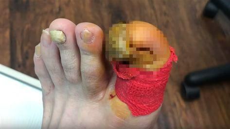 發黴爛甲凹折繼續長！醫快狠準拔除它