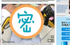 男子孫袋腫到發爛。（圖／翻攝自《每日郵報》） https://www.dailymail.co.uk/health/article-7579765/Man-forced-scrotum-CHOPPED-swollen-dangled-KNEES.html