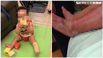 3月大男嬰遭保母燙傷！父：非常自責