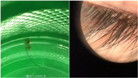 大陸女童玩沙，眼睛感染十幾隻活生生的「陰蝨」。（圖／翻攝自江蘇新聞 微博)
