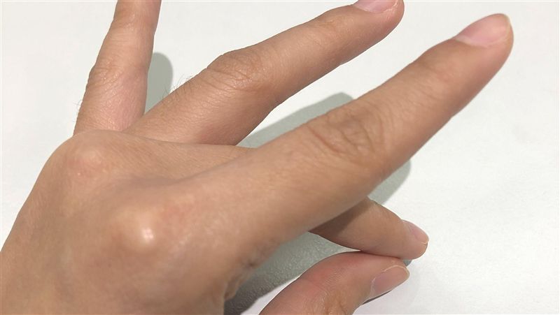 手被膠黏！她竟拿刀「切割蓮花指」