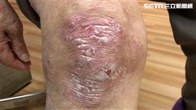 健康,乾癬,精油,洗澡,皮膚,台中慈濟醫院,風濕免疫科,林亮宏
圖／台中慈院提供