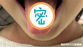  A型鏈球菌是ㄧ種細菌，感染後常會造成咽喉炎、猩紅熱，初期症狀為發燒、喉嚨痛、草莓舌。（圖／醫師邱婷芳提供）