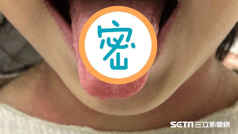 孩「草莓舌」、發燒！恐猩紅熱損心腎