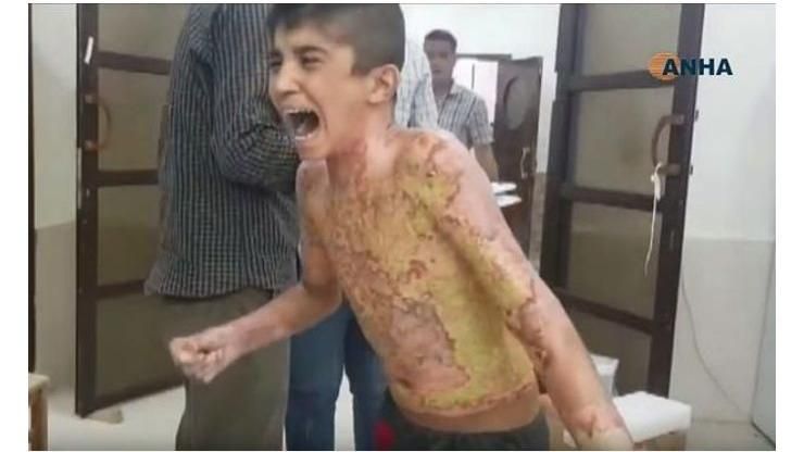 男童嚴重燒傷！對鏡頭哭喊：饒了我吧