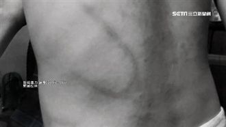 狠父虐打4歲兒　阿公怒：打得像斑馬