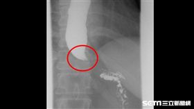 食道攝影檢查，顯影劑全積在食道裡，呈現鳥嘴狀。（圖／義大醫院提供）