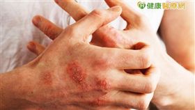 乾癬性關節炎的關節變形無法回復，患者應定期安排X光或超音波等較深層的檢查， 對乾癬性關節炎多一分認識與警覺，預後大不同。