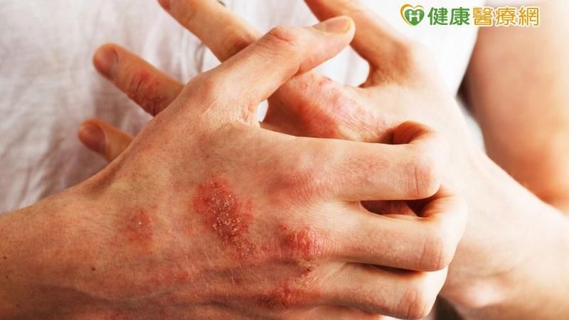 惱人乾癬驚現香腸指　如何對症治療？