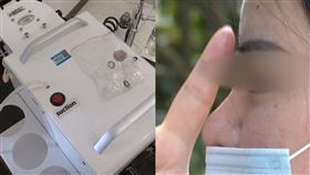 整形,隆鼻,美容,除痘,南京,假體,移位,面皰,處理,賠償,小錢,操作, 圖／翻攝自微博