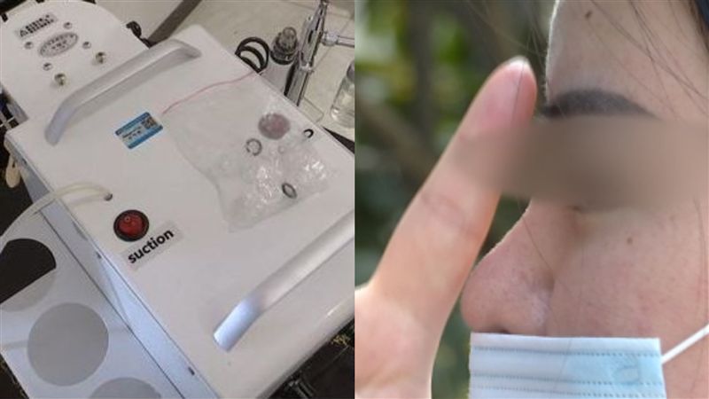 愛美女花百元除痘　卻毀20萬隆鼻！