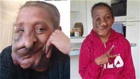 巨瘤吞噬臉！她慘被丟石嫌棄…7小時手術重生：不用再隱藏（圖／翻攝自臉書The Natalia Project）