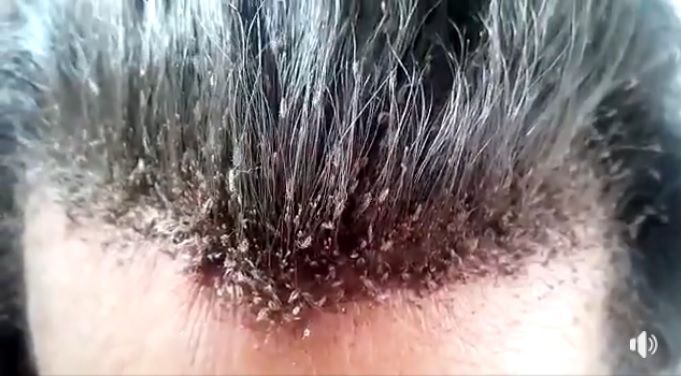 「百萬頭蝨」亂竄！網崩潰：頭皮發麻