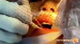 邊走邊吃跌倒！8公分竹籤「直插腦幹」　男童命危送醫
圖／翻攝自微博