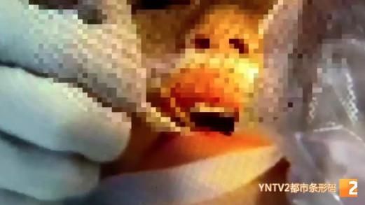邊走邊吃跌倒！8公分竹籤插腦幹