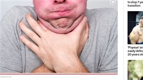 塑膠片,美國,蛋糕,阿伯,手術,食道穿孔
https://nypost.com/2019/10/23/man-didnt-notice-2-inch-cupcake-topper-lodged-in-throat-for-a-week/