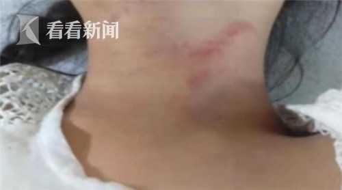 白天睡覺被吵醒！7歲女童遭鄰怒捅刀