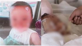 燙傷,熱水,女童,皮掀起,家長,未注意,疏忽