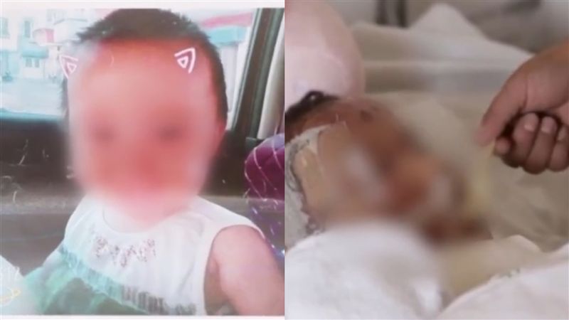 女童掉熱水　母慌掀衣嫩皮跟著被撕下