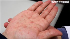 約炮,亞洲大學附屬醫院,感染科,張為碩,紅疹,性病,梅毒