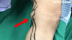 童綜合醫院,肉瘤,靜脈曲張,血管瘤