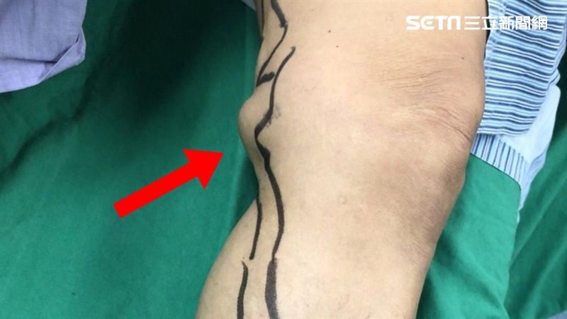 沒感覺不理…婦腿上血管瘤養成雞蛋大
