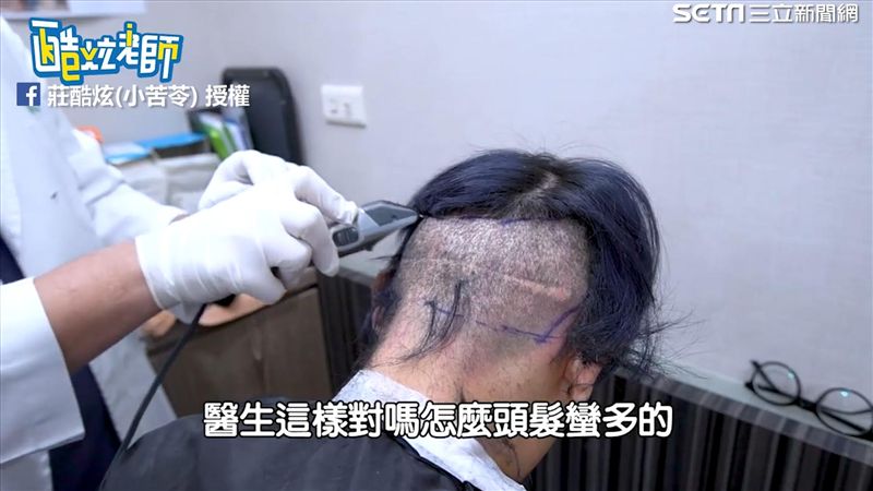 高額頭再見！酷炫公開植髮過程