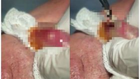 寄生是一種藉由寄生在其他動、植物身上，藉此獲取養分得以生存的一種動物行為，而人類也有可能被其他動物寄生，像是跳蚤、絛蟲等。日前在國外論壇《reddit》裡流傳一則影片，有名男子的嘴唇被名為馬蠅（botfly）的幼蟲所寄生，只見醫生拿鑷子將超大隻寄生蟲取出，畫面超級驚悚，因而嚇壞許多網友（圖／翻攝自Reddit＠u/likklesign）