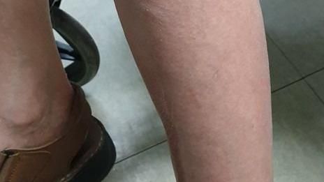 若出現單側下肢腫脹，小腿或大腿疼痛等症狀時，可能與深層靜脈栓塞有關。（圖／翻攝自彰化醫院臉書）