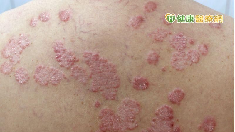 頭皮屑洗不完？　醫師治療有一套