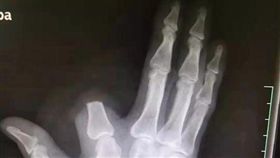 狂男遭蛇咬一口　怕毒發一刀斷指丟棄（圖／翻攝自杭州日報微信公眾號）