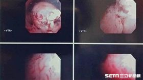 軟式子宮鏡檢查發現子宮內膜極不平整，有如鐘乳石洞凹凸不平。（圖／台北慈濟醫院提供）