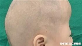吳小妹罹患多條顱縫早閉症，一出生就被發現頭型寬扁，有點像卡通辛普森家庭裡面的頭型。（圖／長庚醫院提供）