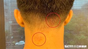 濕疹（陳弋攝影）