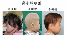 女嬰,頭型,辛普森家庭,罕病作祟,健康(圖/長庚醫院提供)中央社