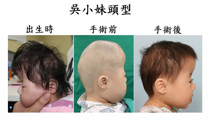 女嬰頭型如辛普森家庭！竟是罕病作祟