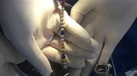 大陸,磁力球,尿道,西安,微創手術。(圖/翻攝自陝西都市快報)