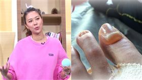 林又立,猛爆性肝炎,水泡。圖／年代提供