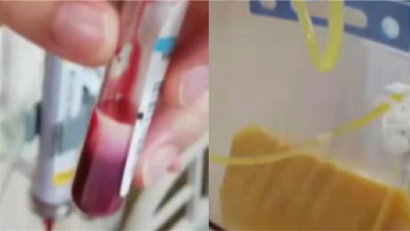 酒後腹部劇痛休克　醫一抽驚見牛奶血