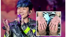 林俊傑  腸病毒 手足口病