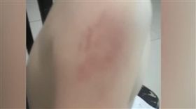 鄭州,牙印,吸的,瘀青,黑青,幼兒園(翻攝梨視頻)