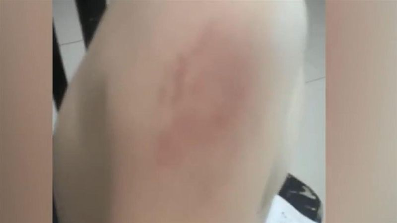 幼兒園師不滿被童咬　報復反咬辯吸的