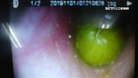 游完泳耳朵劇痛 男就醫驚見綠豆卡耳道