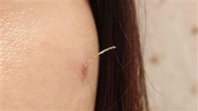 醫美埋線拉提！她驚見左臉竄出線頭　網秒歪樓：打火機拿來（圖／翻攝自爆怨公社）