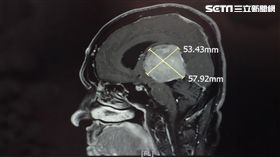 大林慈濟醫院,退化,腦部,雙腳無力,腫瘤,陳金城